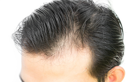 Male Hair Loss