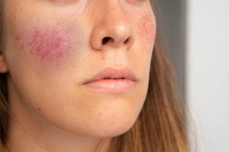 Rosacea